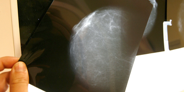  Detección del cáncer de mama. Foto archivo.