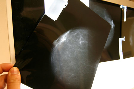 Cáncer de mama golpea más fuerte a regiones rurales y comunidades racializadas en Canadá