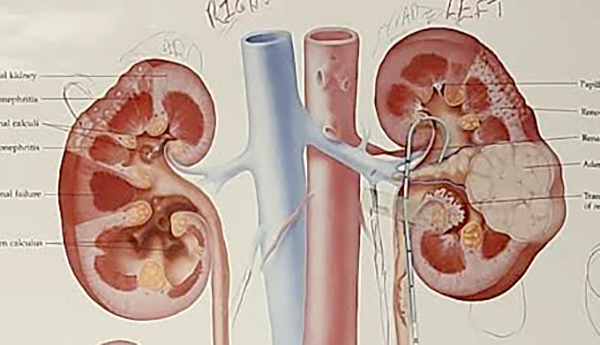 La enfermedad renal puede avanzar en silencio: 3 señales que no debes ignorar